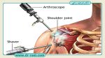 مزایای آرتروسکوپی نسبت به عمل باز