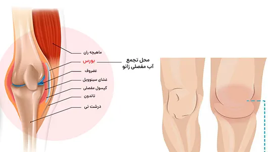 آب اوردن زانو