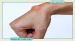 کیست مچ دست چگونه تشخیص داده می‌شود؟