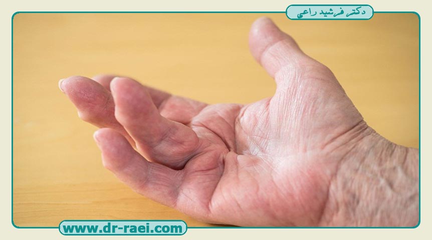All about Dupuytren's contracture