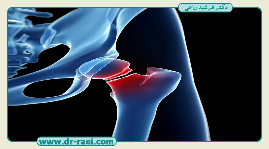 Treatment of subtrochanteric fracture
