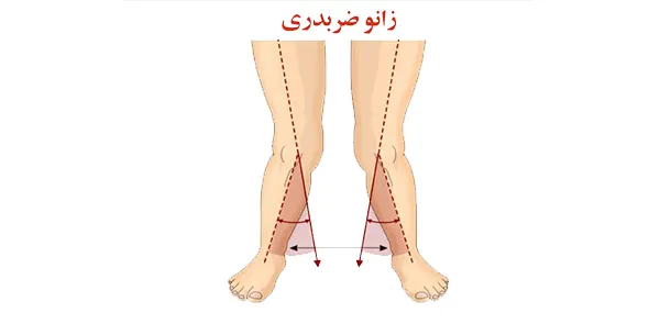 اصلاح زانو ضربدری