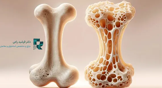 بیماری پوکی استخوان
