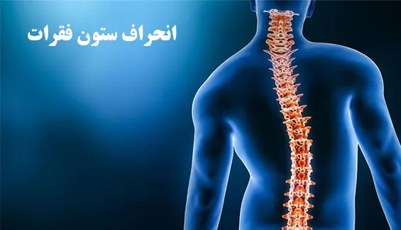 انحراف ستون فقرات