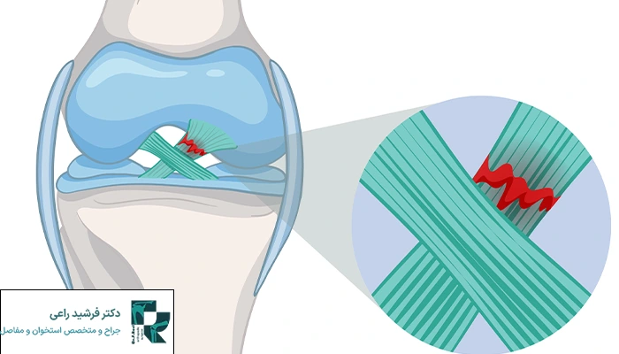 عوارض تعویض مفصل زانو و آنچه درباره آن باید بدانید