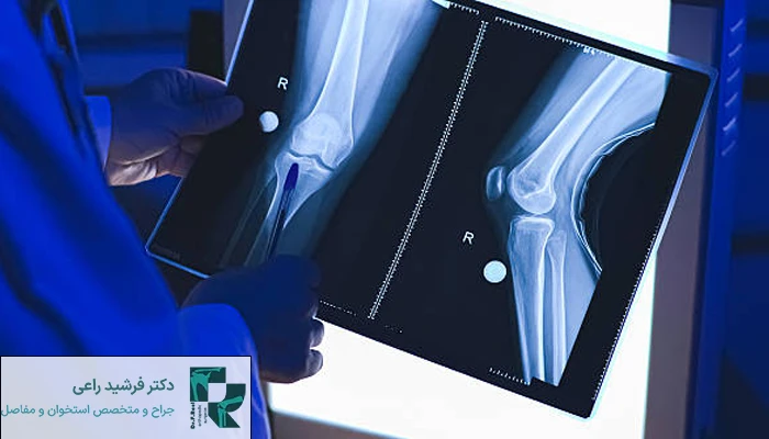 هزینه جراحی تعویض مفصل زانو