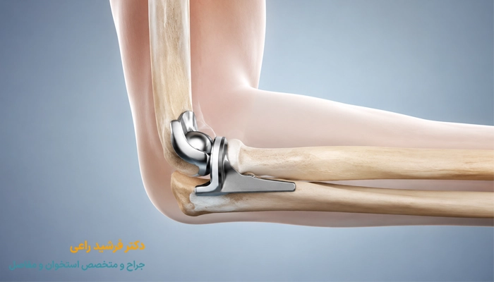 نکات مهم مراقبتی بعد از جراحی آرنج